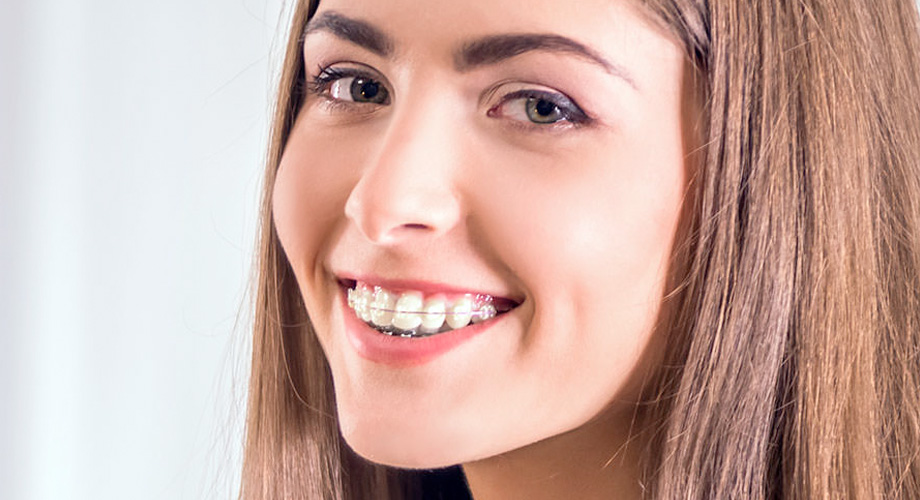 Puntillo and Crane Orthodontics, Clear Braces, Girl with clear braces smiling