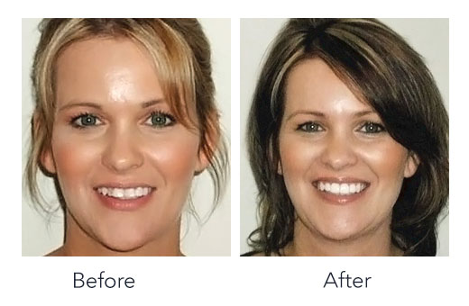 Invisalign Before & After at Puntillo and Crane Orthodontics